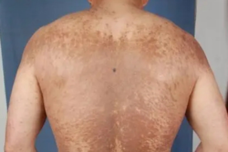 家族性进行性色素沉着症状图