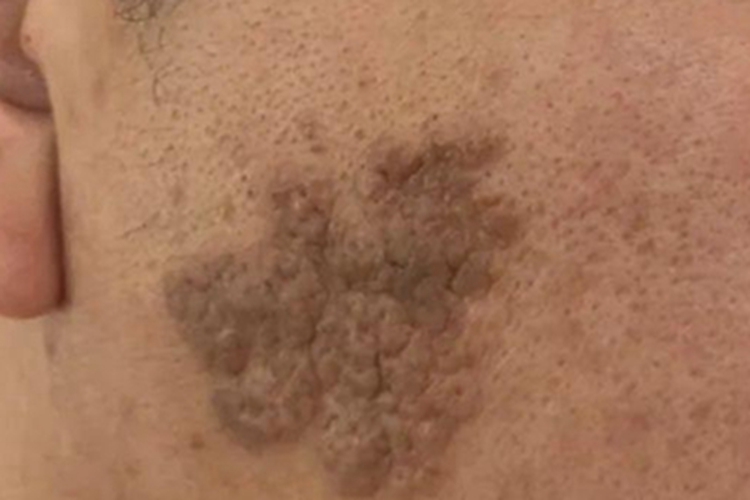 皮脂腺痣面部疙瘩图