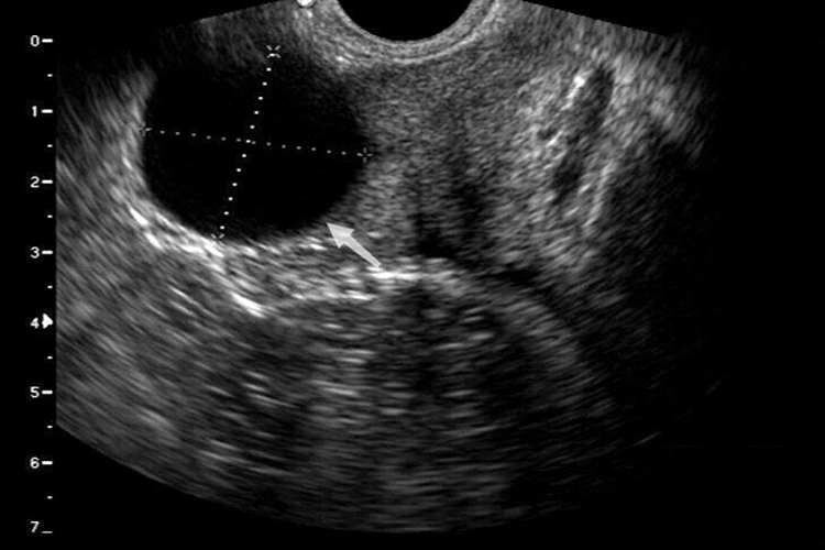 精囊腺囊肿超声图 精囊腺囊肿超声图