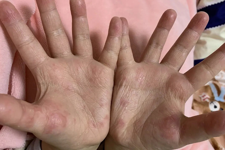 鸡毛过敏引起湿疹图