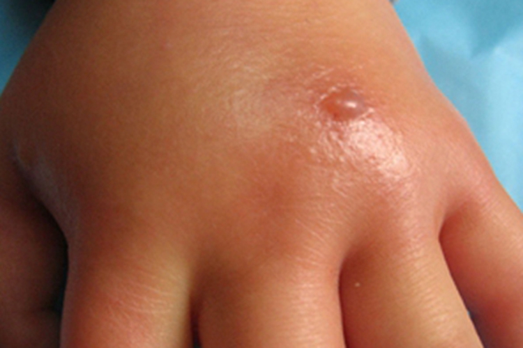 蝎蜇伤手背症状图