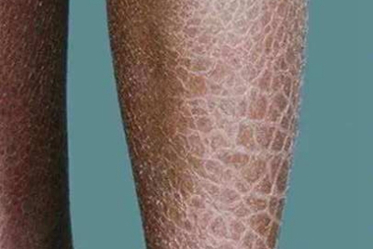 毛囊性鱼鳞病小腿症状图 毛囊性鱼鳞病小腿症状图