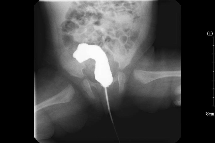 婴儿肛门狭窄影像图