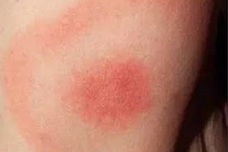 慢性游走性红斑腰部症状图