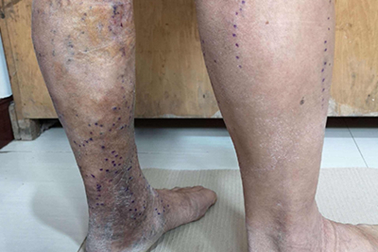 血栓性浅静脉炎腿上红筋图 血栓性浅静脉炎腿上红筋图