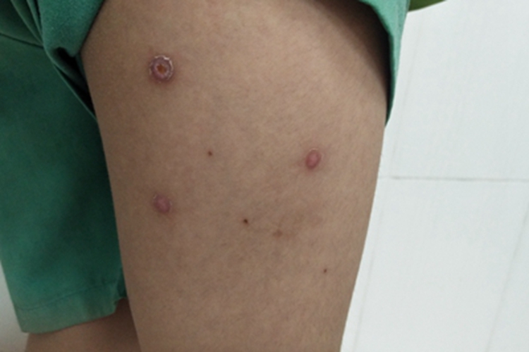 水痘右大腿背侧有瘢痕图