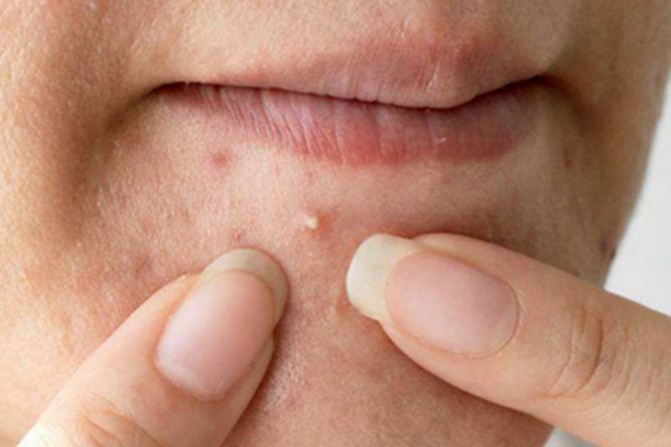 毛囊炎下巴疙瘩图