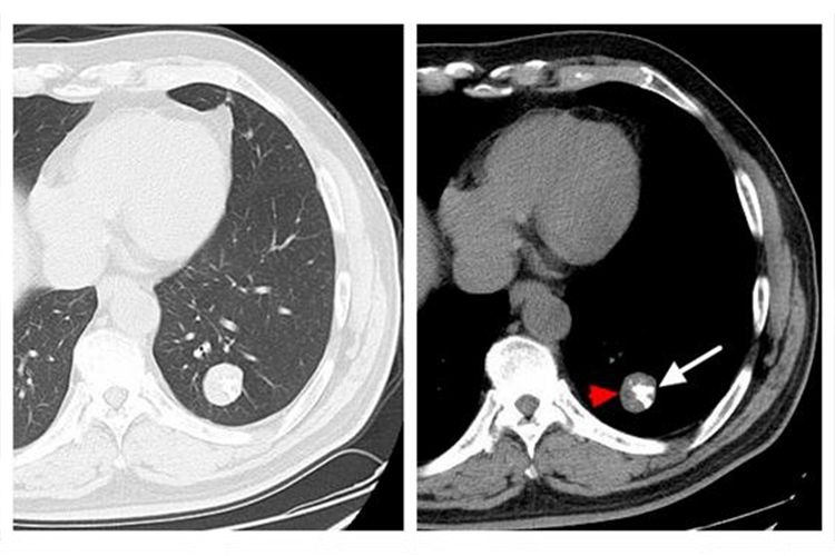 肺部良性肿瘤图