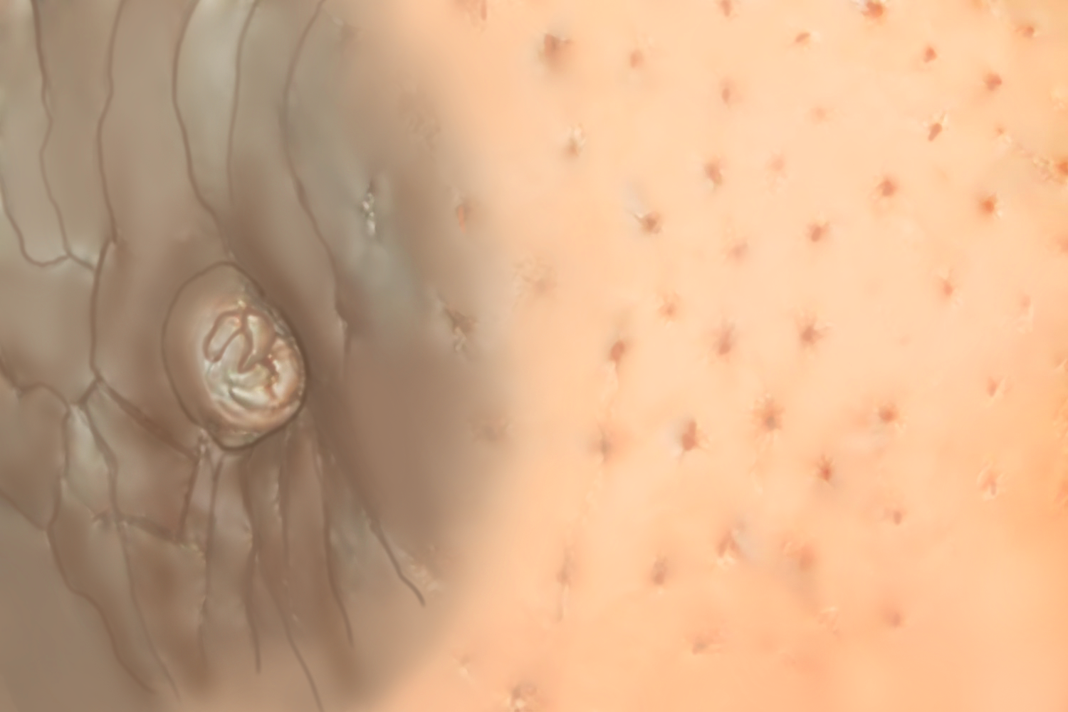 乳腺癌乳房小坑手绘图