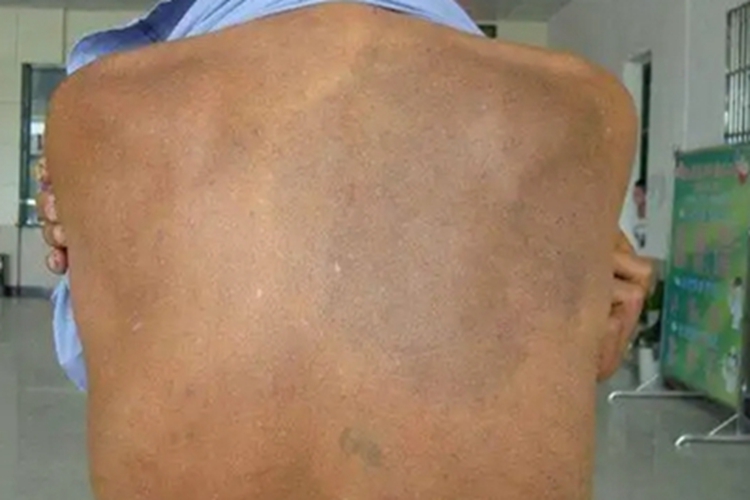 黑变病背部长斑图 黑变病背部长斑图