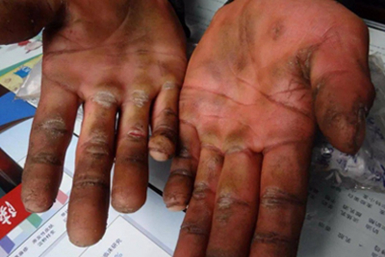 表皮松解性掌跖角皮症裂口图