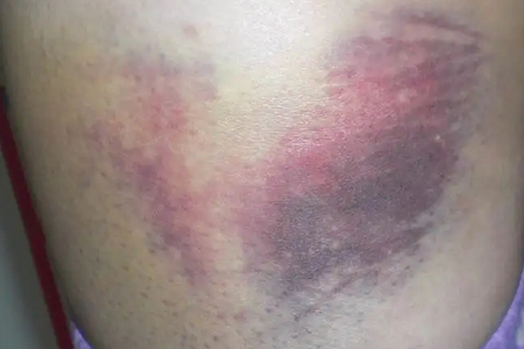 挫伤皮肤瘀斑图