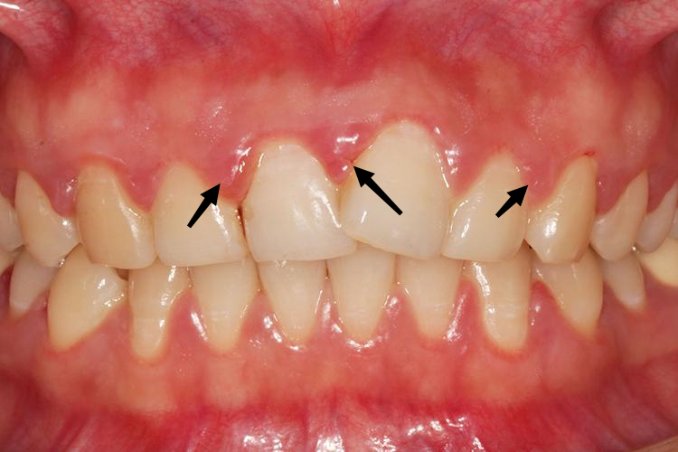 妊娠期龈炎牙龈增生图 妊娠期龈炎牙龈增生图