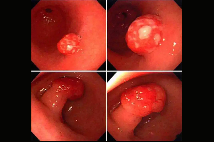 食管息肉图 食管息肉图