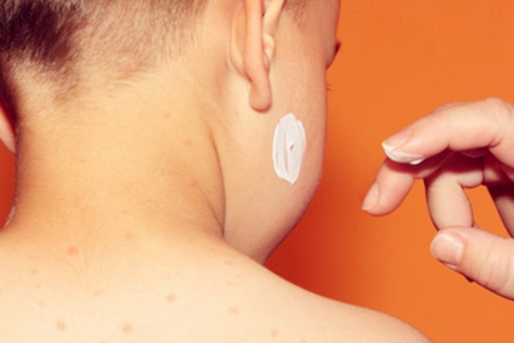 儿童轻微猩红热皮疹图