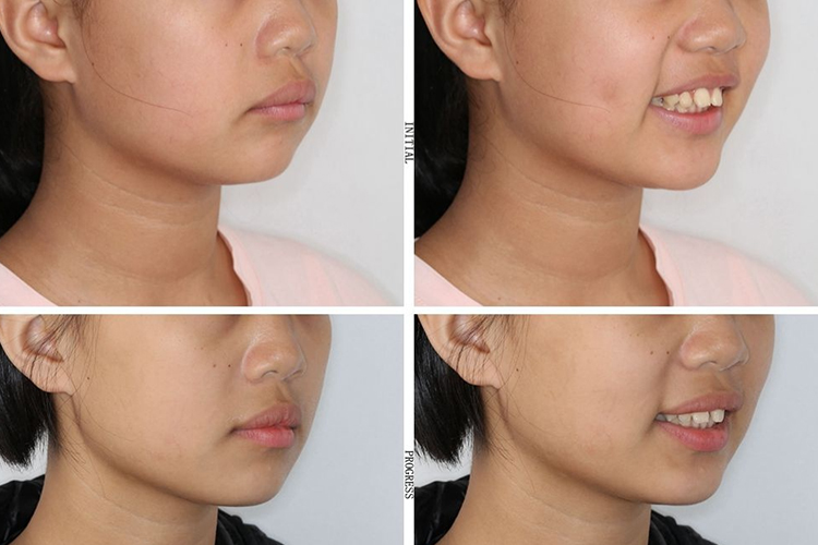 腺样体面容牙齿矫正前后对比图 腺样体面容牙齿矫正前后对比图