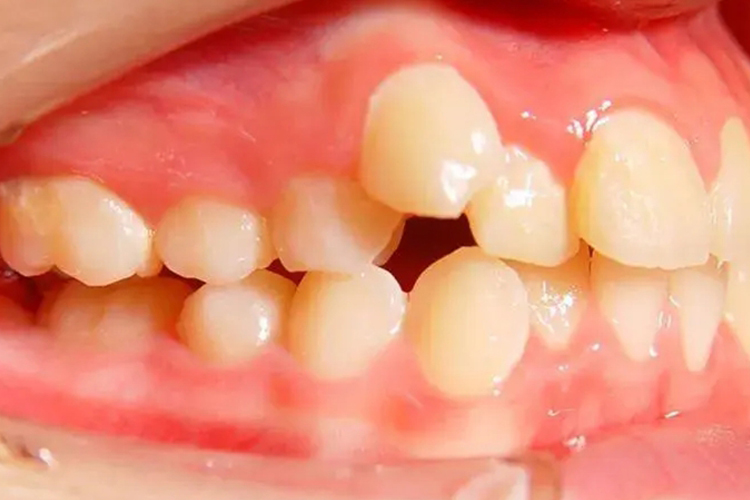 牙齿畸形牙列不齐图