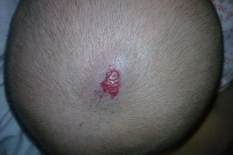 婴儿血管痣图 婴儿血管痣图