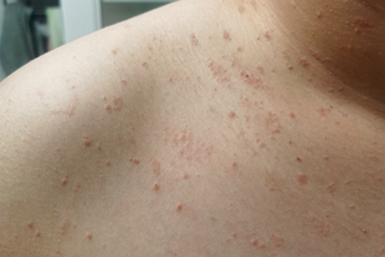 毛囊炎肩部症状图