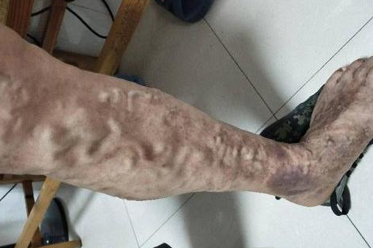 左髂静脉压迫综合征静脉曲张图