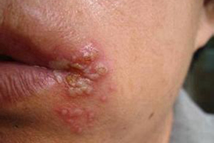 唇疱疹口周有密集黄色水疱图