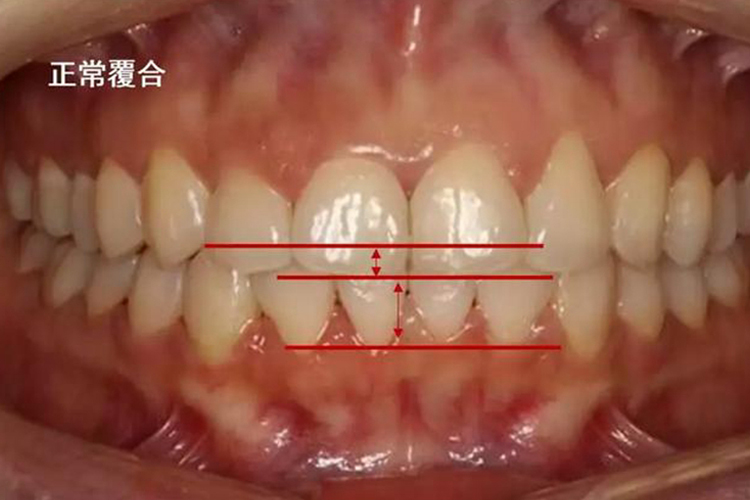 上颌中切牙正常咬合关系图