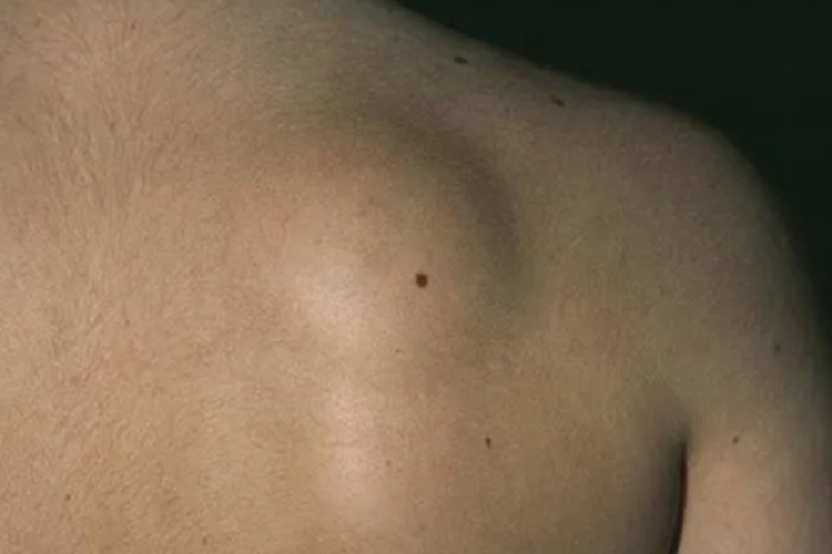 脂肪瘤背部肩胛骨有包块图