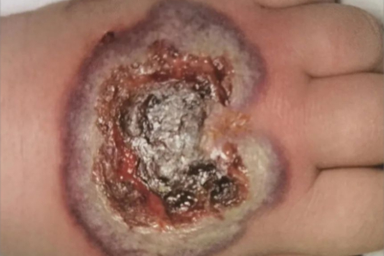 急性发热性嗜中性皮病手背水疱图