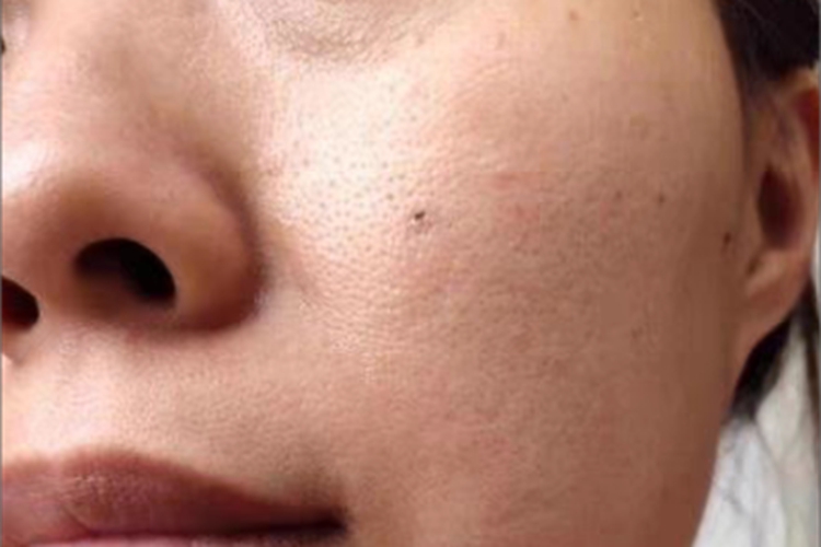 交界痣脸上有个黑点图