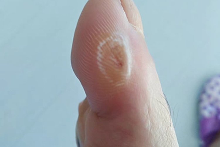 寻常疣脚趾症状图 寻常疣脚趾症状图