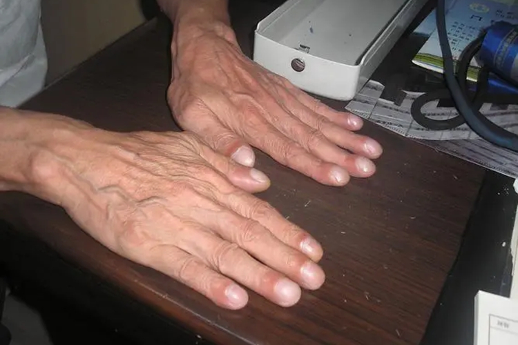 十个手指头末端变粗大图