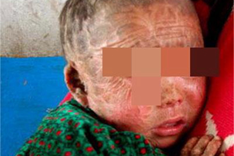 鱼鳞病面部结痂图