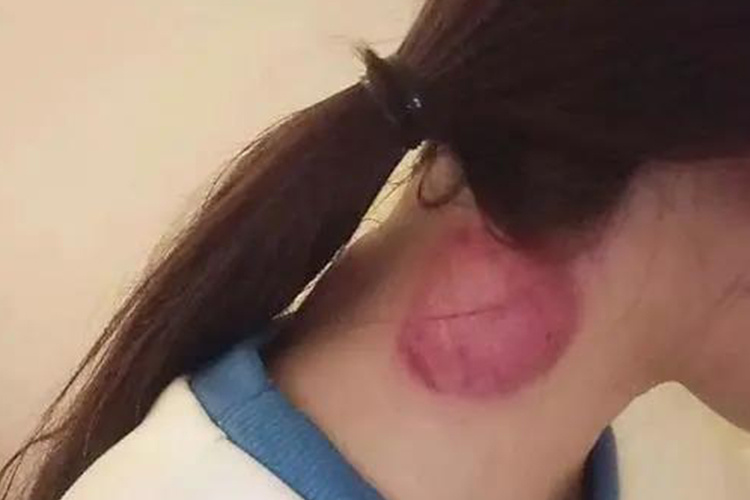 拔罐后皮肤颜色淡红图 拔罐后皮肤颜色淡红图