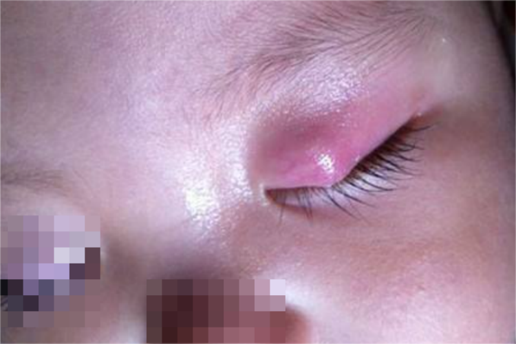 睑板腺囊肿图 睑板腺囊肿图