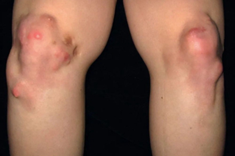 皮肤钙沉着症膝盖结节图 皮肤钙沉着症膝盖结节图