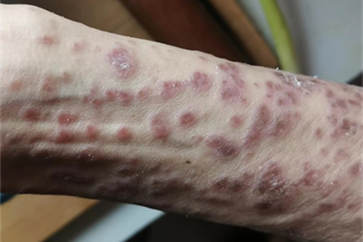 移植物抗宿主病胳膊红斑图