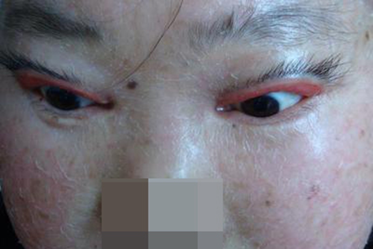 板层状鱼鳞病眼睑症状图 板层状鱼鳞病眼睑症状图