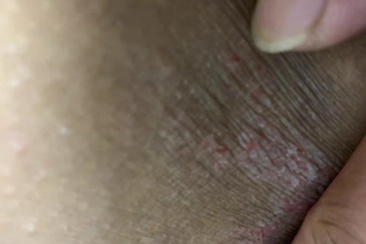 股癣大腿脱屑图 股癣大腿脱屑图