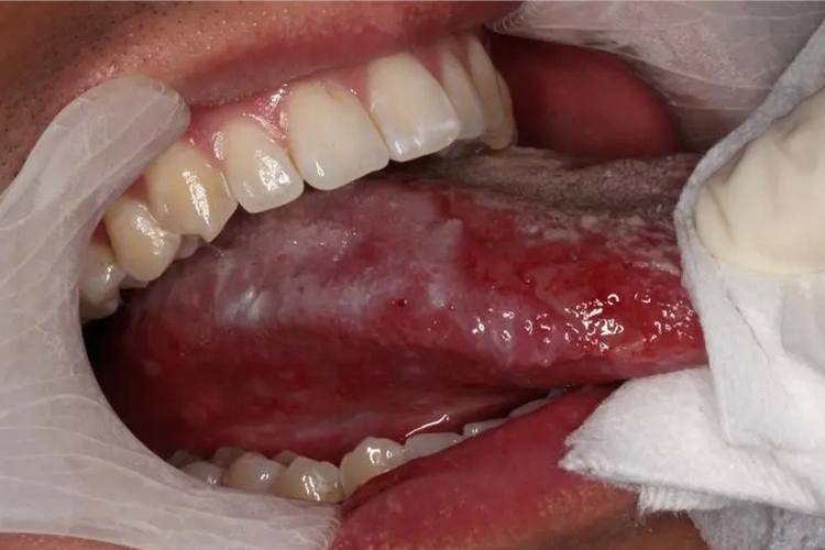 慢性移植物抗宿主病舌侧白斑图