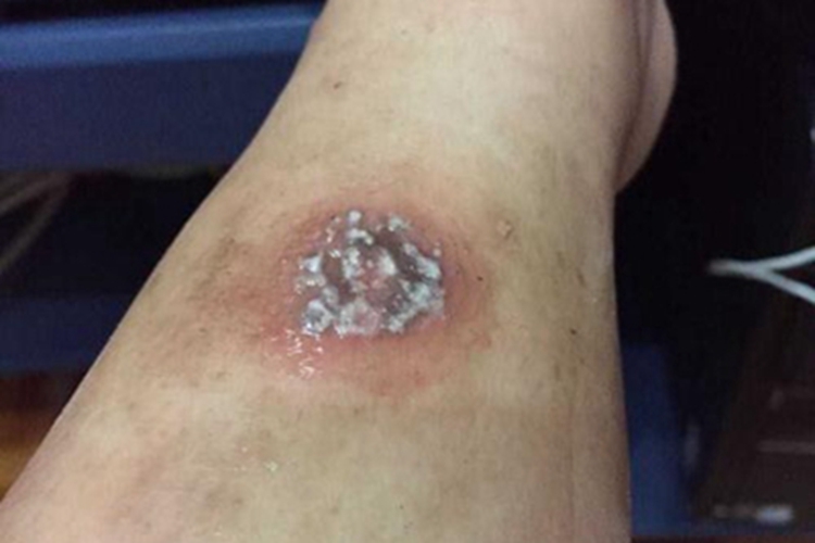 体虱病小腿被咬了流脓图