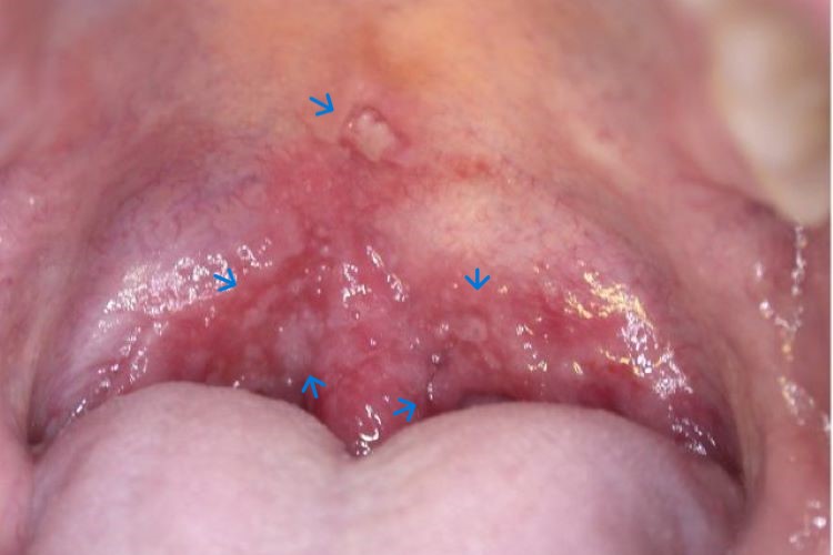 二期梅毒喉咙起疱图