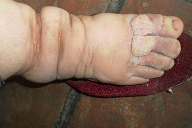 慢性期皮肤丝虫病皮肤增厚图