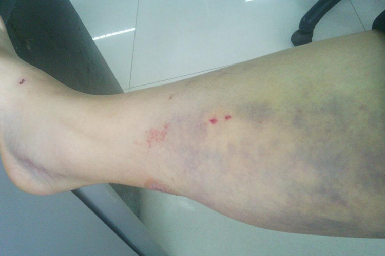 白血病淤青图 白血病淤青图