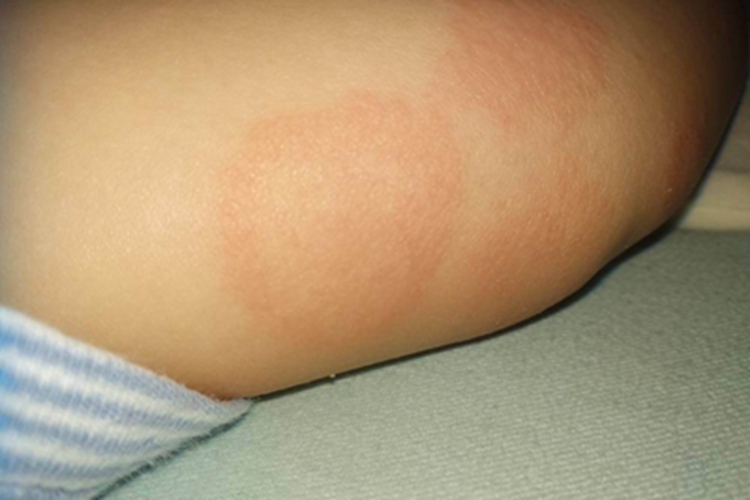 连圈状秕糠疹斑片图 连圈状秕糠疹斑片图