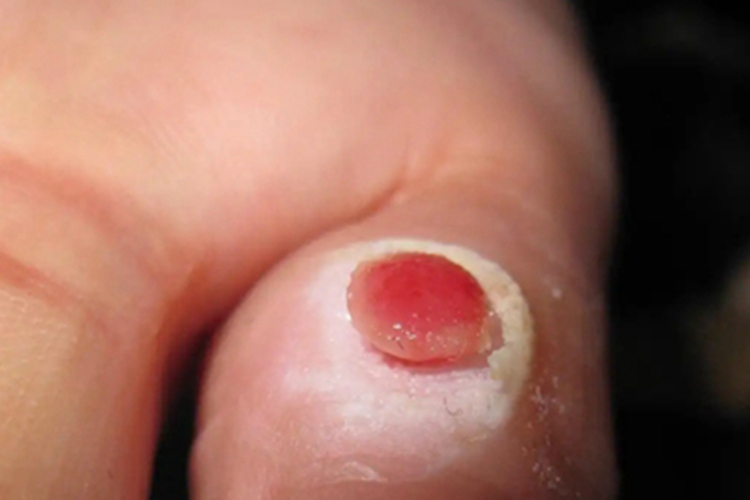 毛发肉芽肿手部肉球图 毛发肉芽肿手部肉球图