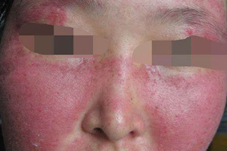 系统性红斑狼疮图