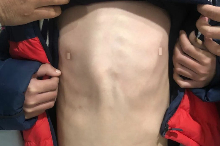 鸡胸导致的心窝下硬包图