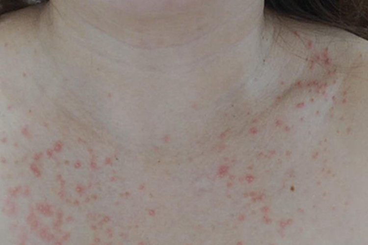 细菌性毛囊炎胸部症状图