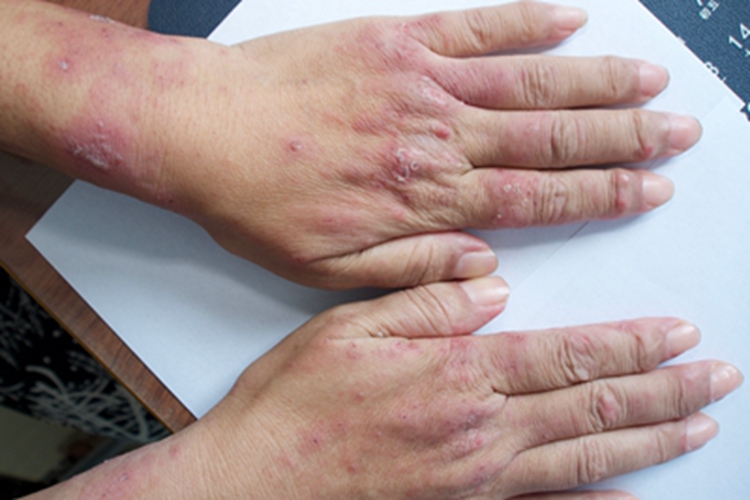 特应性皮炎手背皮肤粗糙图 特应性皮炎手背皮肤粗糙图
