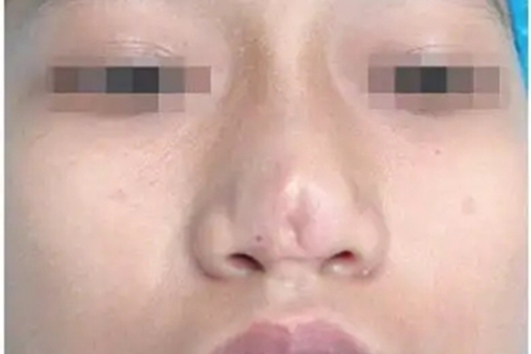 先天性鼻正中裂鼻尖症状图